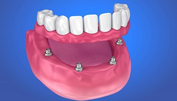 four dental implants supporting a full denture on the lower arch 