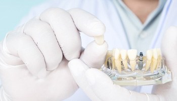 a model of how dental implants work
