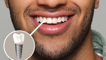 A photo highlighting a young man’s dental implant