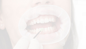 An image of a dentist whitening a patient’s smile while having them wear Optragate lip and cheek retractors