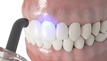 Illustration of dental bonding in Metairie, LA