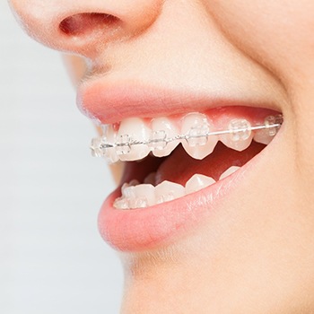 Close up of woman smiling with braces in Metairie