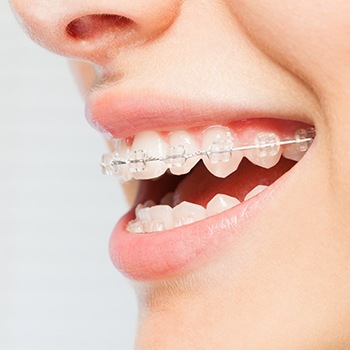 Close up of woman smiling with braces in Metairie