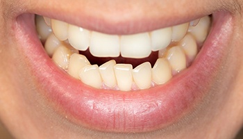 Close up of crowded and crooked smile