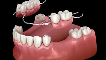 partial denture replacing several teeth along the bottom arch 