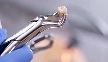 Close-up of forceps holding tooth after tooth extraction in Metairie, LA 