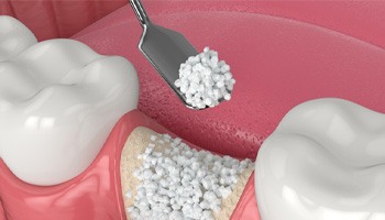 a digital illustration showing how a bone graft works