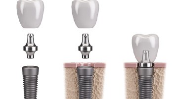 digital illustration of the three parts of a dental implant