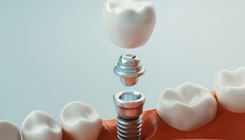 a digital illustration of an implant crown