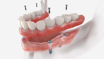 a digital illustration of a implant dentures