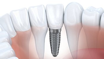 Cartoon depiction of a dental implant