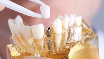 Model of an implant-retained crown