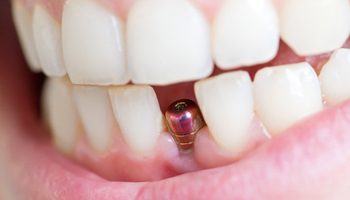 smile with dental implant showing
