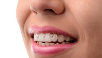Woman wearing Invisalign