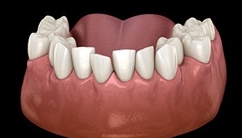 Illustration of crowded teeth in lower arch