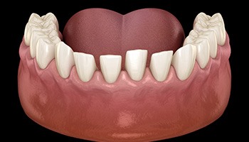 Illustration of teeth spaced too far apart