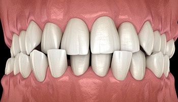 Illustration of close-up of crossbite