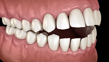 Illustration of an open bite