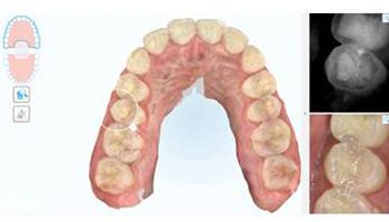 images and xrays of bottom teeth