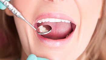 Woman's teeth being examined with dental inspection mirror