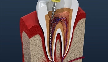 Root canal procedure