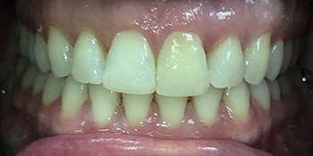 Smile Story After