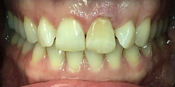 Smile Story Before