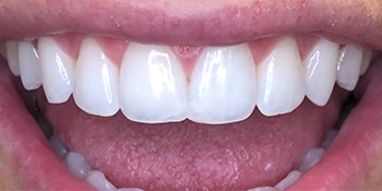 Smile Story After