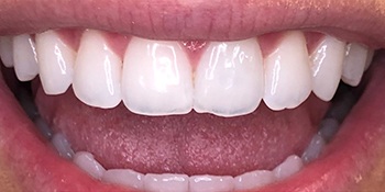 Smile Story Before