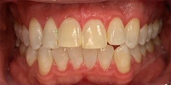 Smile Story Before