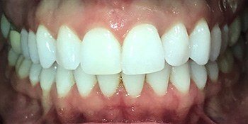 Smile Story After