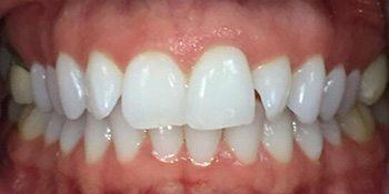 Smile Story Before