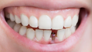 Smile with dental implant