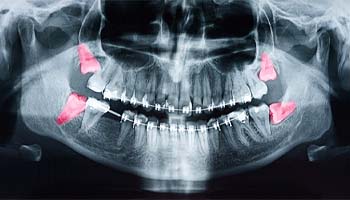 X-ray of wisdom teeth in Metairie