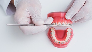 A dentist uses a dental instrument to show how traditional braces work on a mouth mold