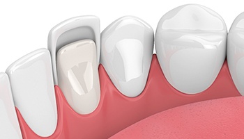 porcelain veneer illustration