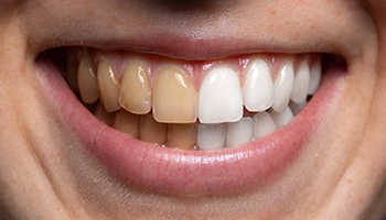 Before and after teeth whitening