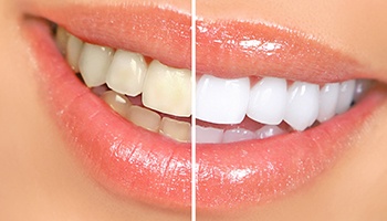Before and after Zoom! whitening results in Metairie