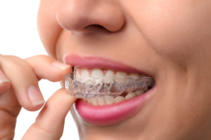 Woman wearing invisible orthodontic trays