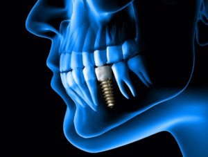 Digital model of single dental implant